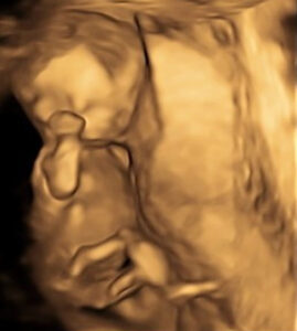 Ultrasound Photo