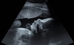 2D Ultrasound Photo